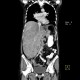 Multiple myeloma, venooclusive disease of liver, hypervascular nodules: CT - Computed tomography